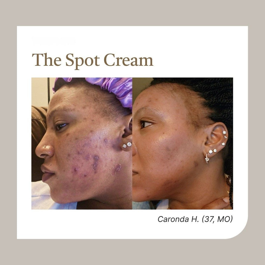 ✨Musely "The Spot Cream": Adiós melasma, hola piel radiante.
